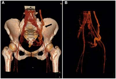 Ovarian Vein Embolization With N-butyl-2 Cyanoacrylate Glubran-2® for the Treatment of Pelvic Venous Disorder